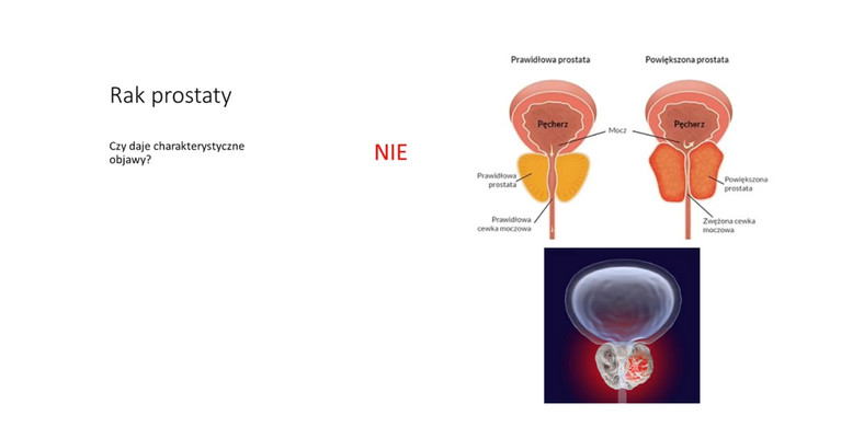 Rak prostaty - slajd pokazywany na konferencji