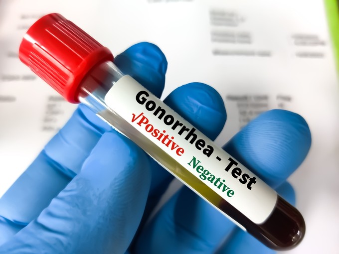 Engedélyezték a chlamydia és a gonorrhoea első otthoni tesztjét