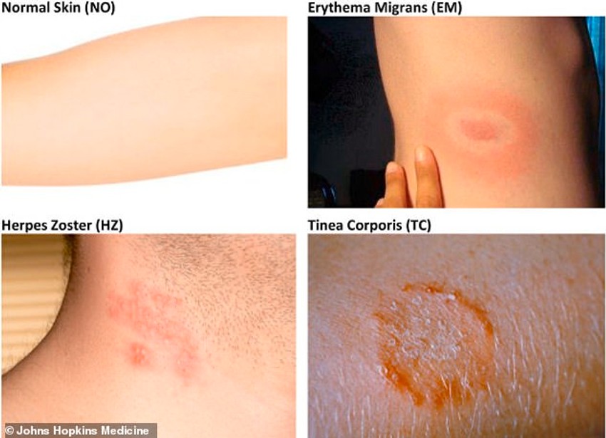 Osip, lajmska bolest