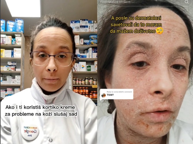 Farmaceutkinja Anđela je koristila kortikosteroide za lice, a sad se sučava sa užasnim nuspojavama