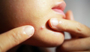 Jak wycisnąć pryszcza, żeby nie uszkodzić skóry? Przestrzegaj tych zasad, jeśli nie umiesz trzymać rąk przy sobie