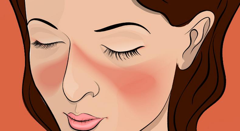 These are the 7 early warning signs of lupus you should watch out for [Credit: Aus Med]