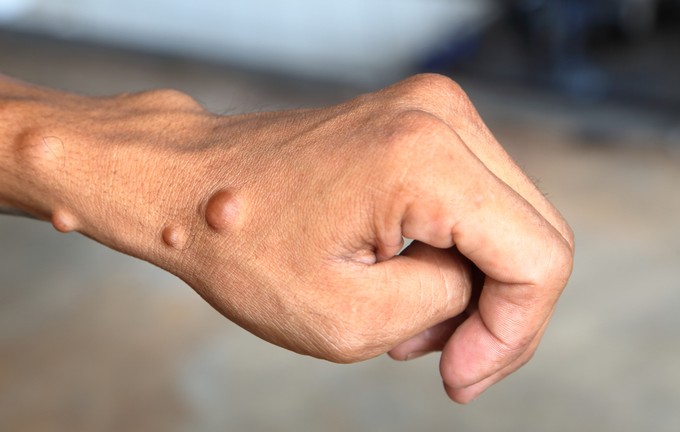 Majomhimlőnek nézte a lány bőrdaganatait a vonaton, ezt tette vele