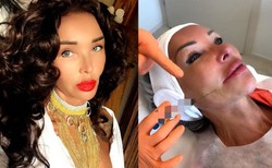 Ewa Minge pochwaliła się wymodelowaną twarzą: Otrzymałam nową żuchwę