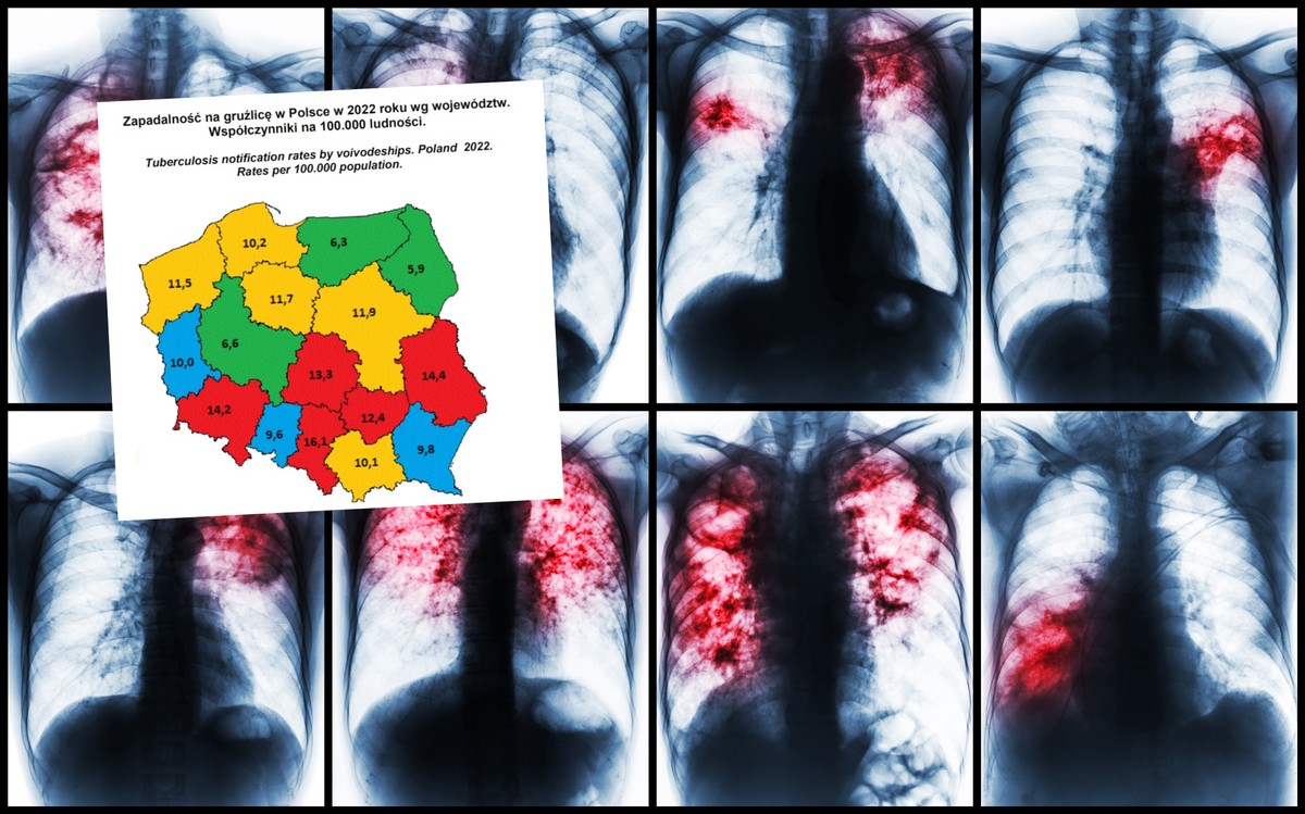 Wraca zapomniana choroba, do Polski także