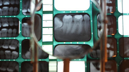 RTG zęba - kiedy wykonać, co można na jego podstawie zdiagnozować, jak przebiega