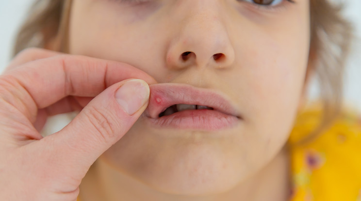 A száj belső részén kis pattanásszerű gyulladás az afta/Fotó: Shutterstock