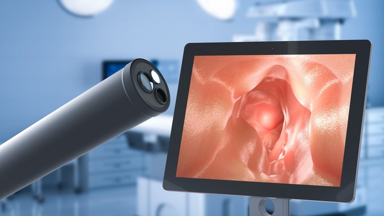 kezeletlen fekély vastagbélgyulladás tumor rák következmény