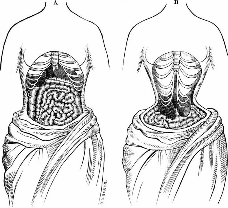 Corsets were the old-fashioned versions of waist trainers and were responsible for shifting vital organs and causing health problems [Credit: Forbes]