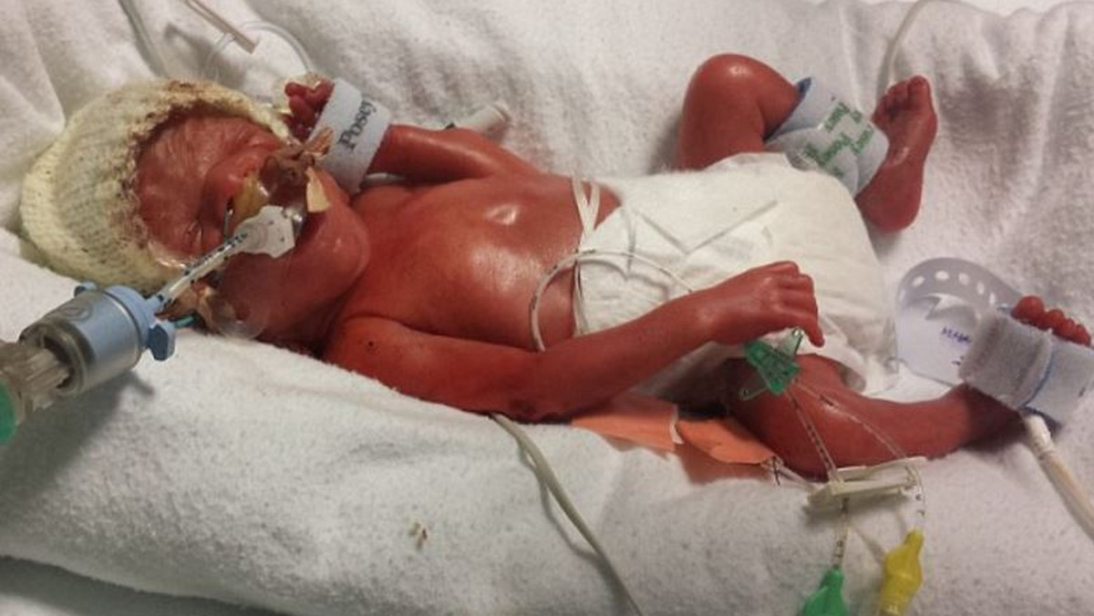 Kalel Fitz to obecnie dwuletni chłopczyk z Wielkiej Brytanii, który przyszedł na świat w 23. tygodniu ciąży i ważył zaledwie 0,7 kilograma. Lekarze dawali mu 50 proc. szans na przeżycie, jednak teraz dziecko ma się świetnie.