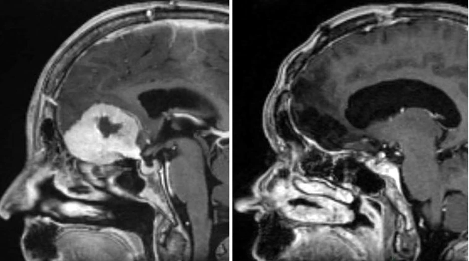 Snimak tumora na mozgu (levo) i nakon uklanjanja (decno)