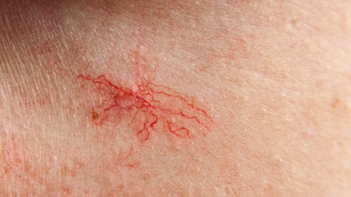 Ovi crveni, plavi ili ljubičasti klasteri koji izgledaju kao paukova mreža, pojavljuju se duž obraza i nosa