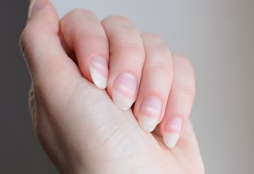 fehér foltok, köröm, körömbetegség, vitaminhiány