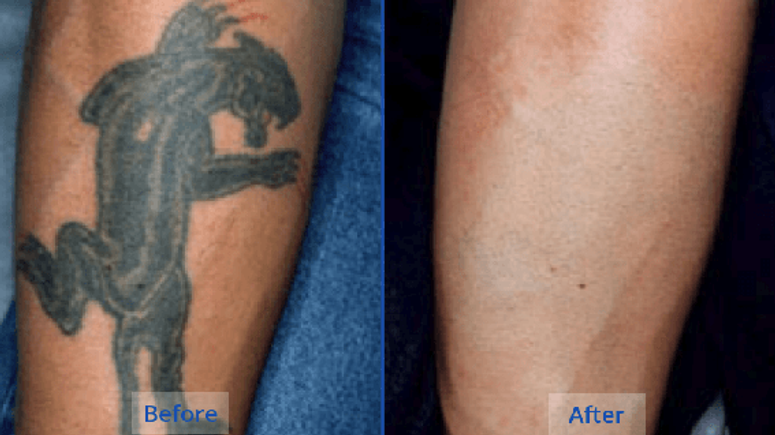 5 Natural Tattoo Removal Remedies You Can Try At Home Pulse Ghana