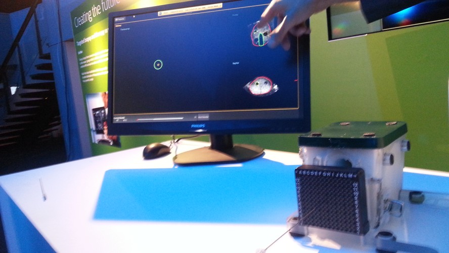 Ryzyko rozwoju raka prostaty dotyczy aż 1 na 6 mężczyzn. Ciągle potrzebne są więc metody bardziej ekonomicznej i spersonalizowanej terapii oraz opieki nad pacjentami ze zdiagnozowanym nowotworem. 
<br>
Philips stworzył nową metodę obrazowania i monitorowania przebiegu brachyterapii ogniskowej, która ułatwia lekarzom diagnozowanie i leczenie chorych. 
<br>