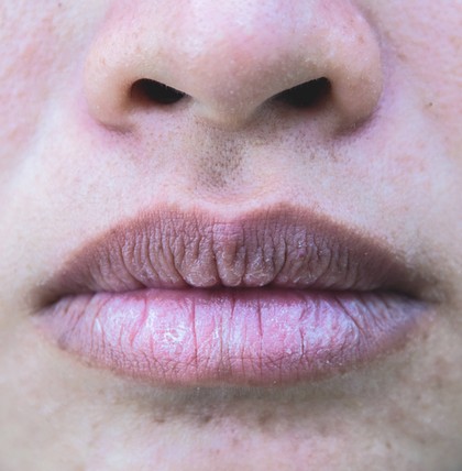 Sind die Lippen ständig spröde, an den Mundwinkeln entzündet oder weisen eine ungewöhnliche Färbung auf, kann sogar eine Krankheit dahinter stecken.