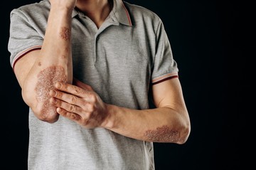Élet pikkelysömörrel: a korszerű terápia minden érintettnek kijár
