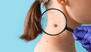 Određene karakteristike mladeža mogu da ukazuju na melanom