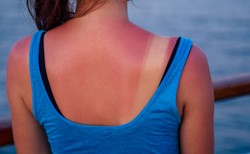 Zobacz, zanim kolejny raz spieczesz się na słońcu: TAKIE uszkodzenia w skórze powoduje zbyt długie opalanie