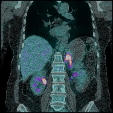 Guzek nadnercza lewego w badaniu PET-CT 