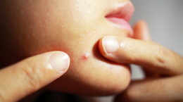Jak wycisnąć pryszcza, żeby nie uszkodzić skóry? Jeśli nie umiesz trzymać rąk przy sobie, przestrzegaj tych zasad