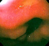 endoscopy1-d00000EB3ee0859f1dc7e
