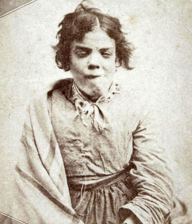 Pacjenta angielskiego zakładu dla obłąkanych na fotografii z połowy XIX wieku