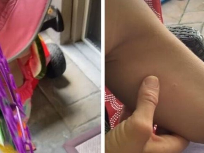 Reakcija devojčice na ubod stršljena