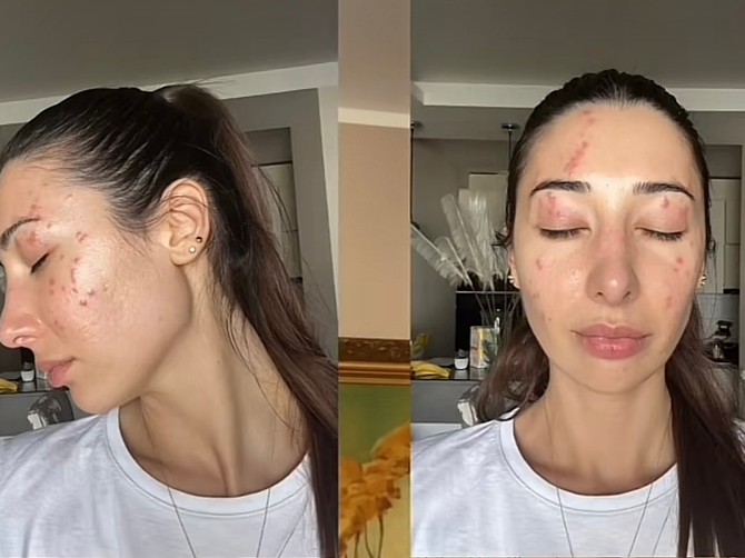 Ninu su stenice izujedale po celom licu i telu, što je izazvalo alergijsku reakciju