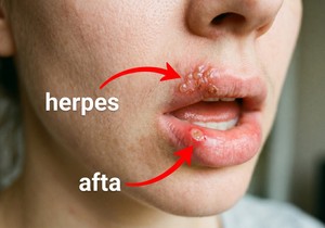 Herpes i afta, ilustracija kreirana uz pomoć AI.