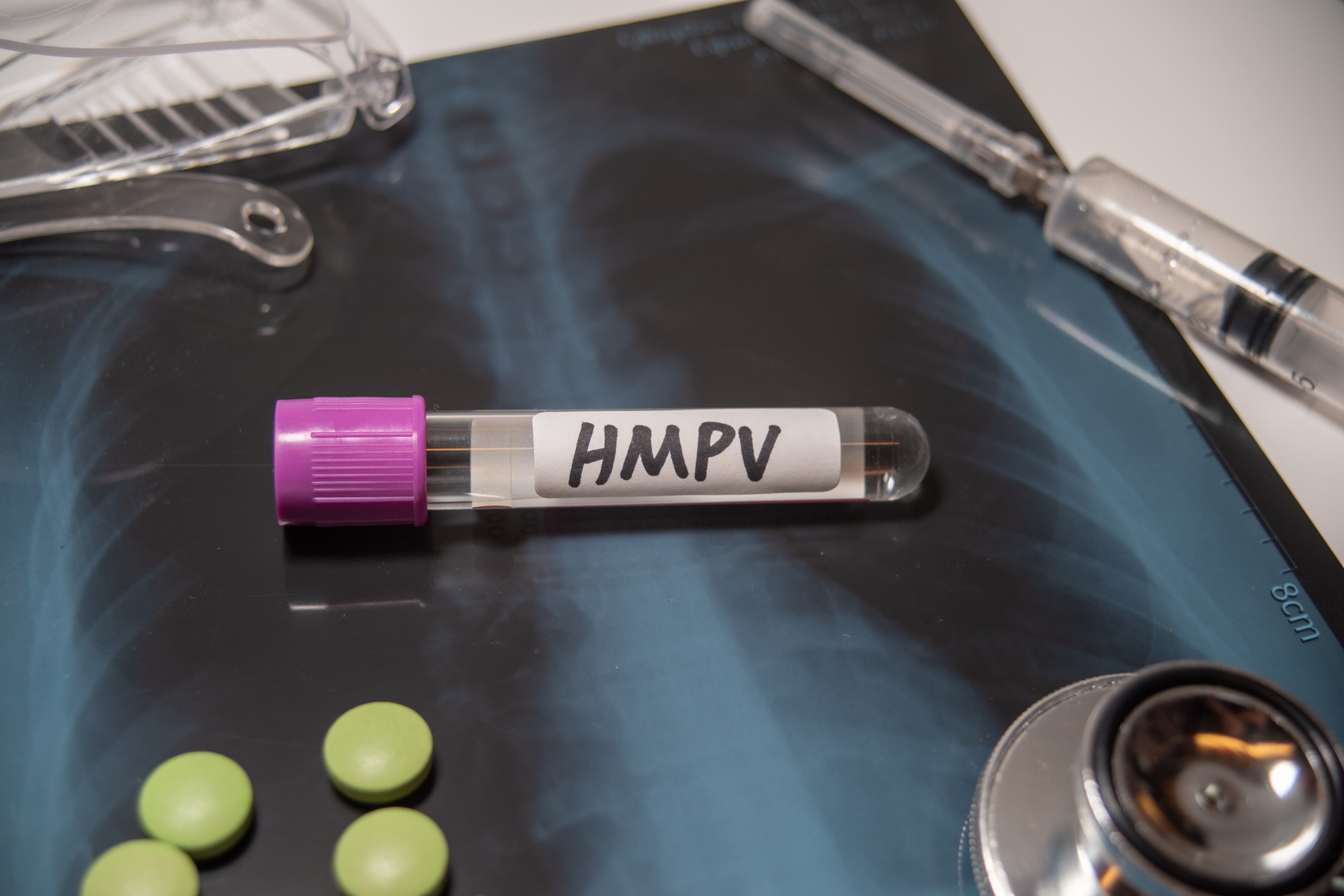 Prípady ľudského metapneumovírusu (HMPV) vzbudili obavy (ilustračné foto).