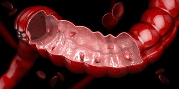 vastagbélrák, vastagbéldaganat, rák, tumor
