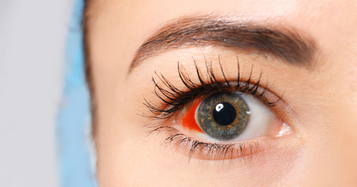 Wylew w oku - przyczyny, objawy i metody leczenia