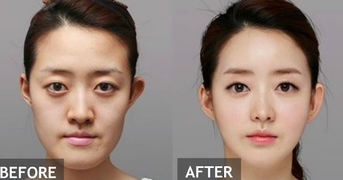 kpop plastic surgery