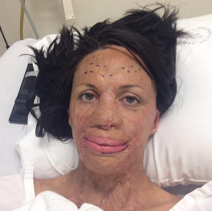 Turia Pitt