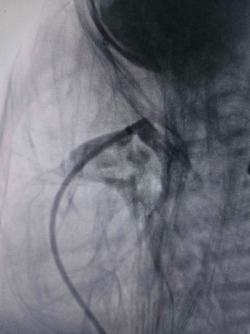 Čitava procedura rađena je pod kontrolom ultrazvuka