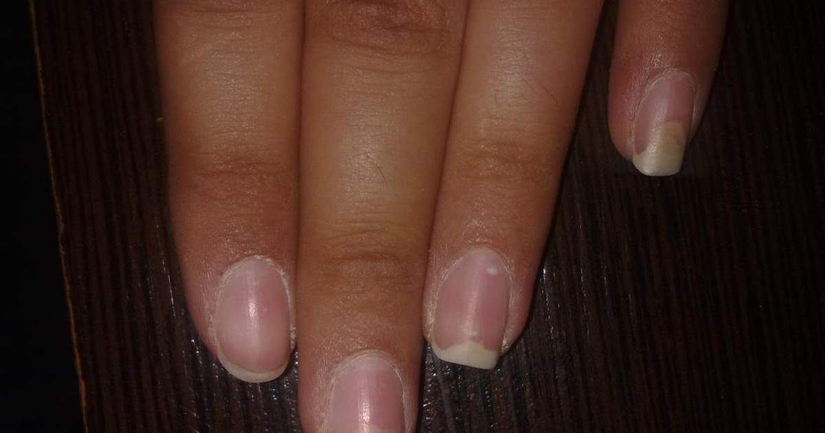 Causes and treatment of fingernails falling off Pulse Nigeria