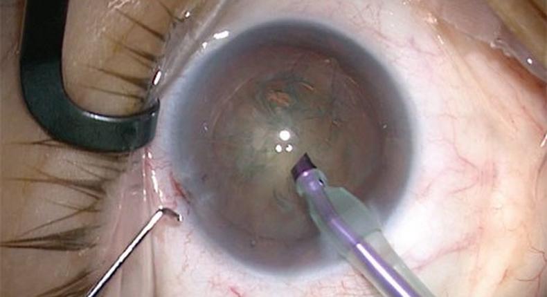 5 causes and symptoms of cataract