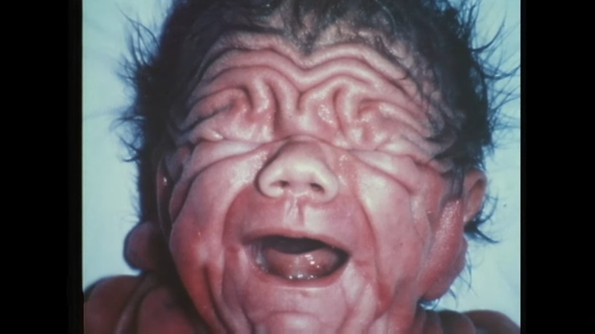 Na rođenju je izgledao kao šar pej, imao je količinu kože jednog petogodišnjaka