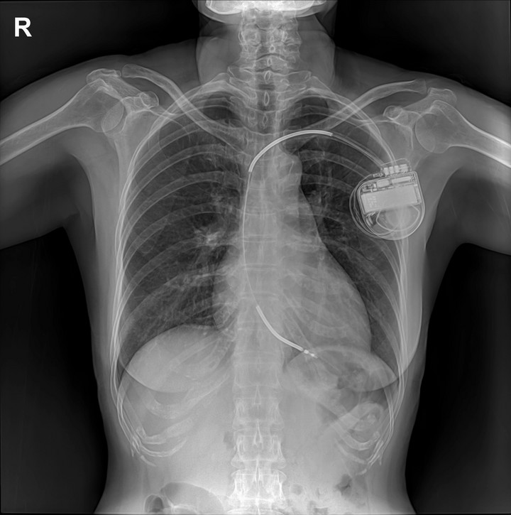 Kardiowerter-defibrylator widoczny na zdjęciu rentgenowskim