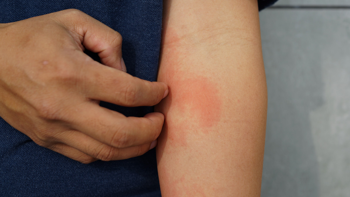 Alergia skórna: co ją wywołuje? Objawy, leczenie, badanie, wizyta u lekarza
