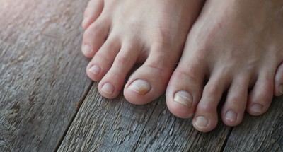 Grzybica Dermatofitowa Paznokci Przyczyny Objawy Diagnostyka Leczenie Zdjecia