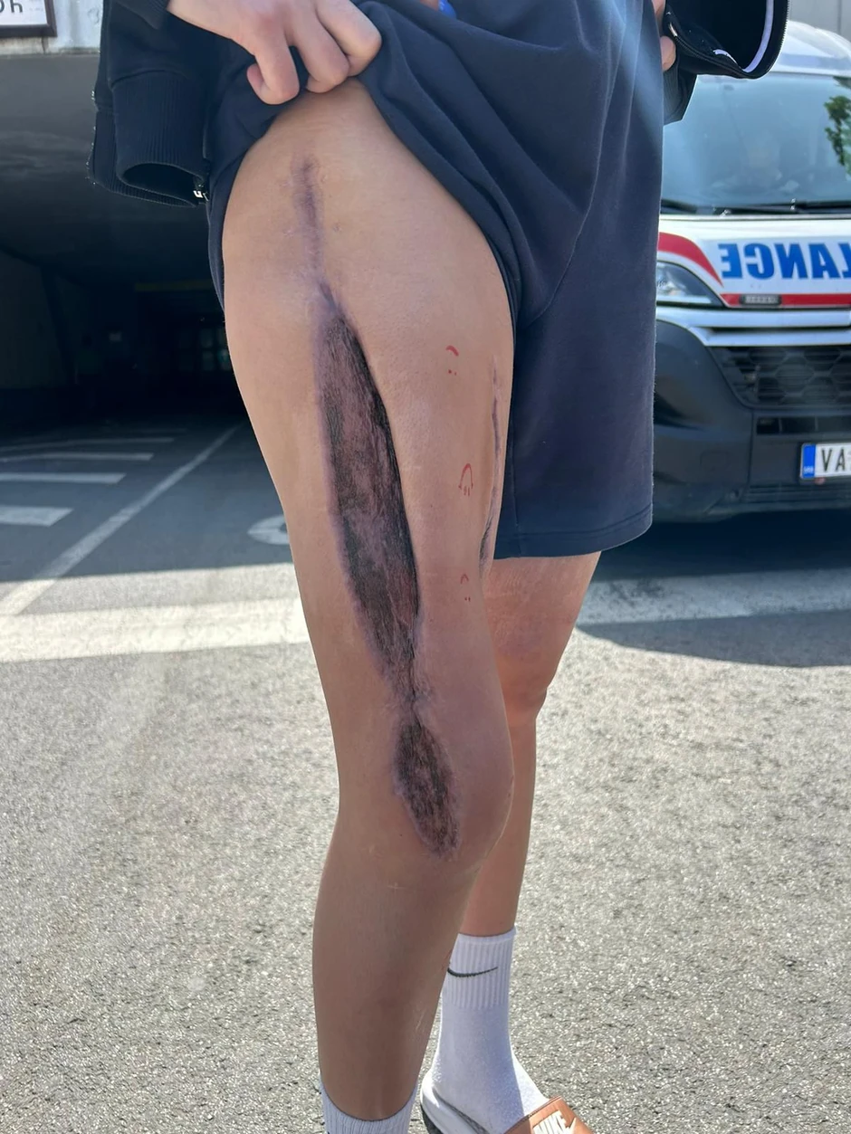 Noga joj je isečena sa obe strane i ne može da savije koleno