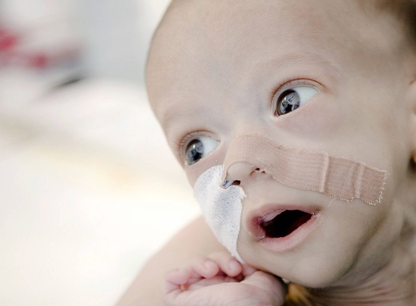 Andrej ima samo devet centimetara creva, dok druge bebe njegovog uzrasta imaju oko tri metra