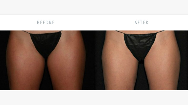 Some people go under the knife to have a free thigh gap [Healthline]