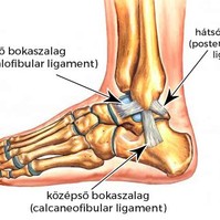 Mi az ínszalagszakadás?