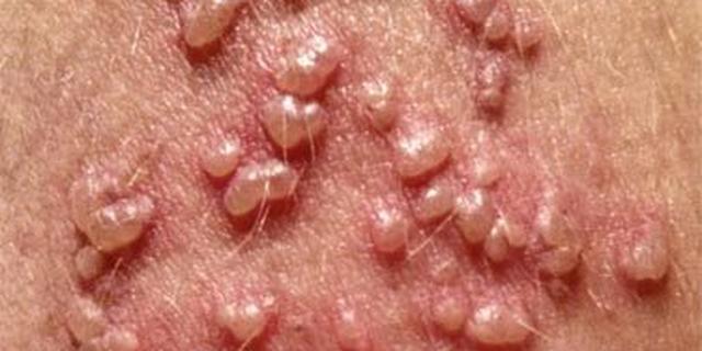 Genital herpes of Symptoms Of