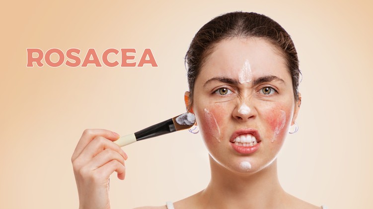 rosacea, bőrpír, bőrbetegség