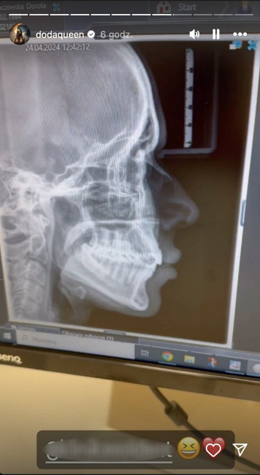 Doda pokazała zdjęcie rentgenowskie.