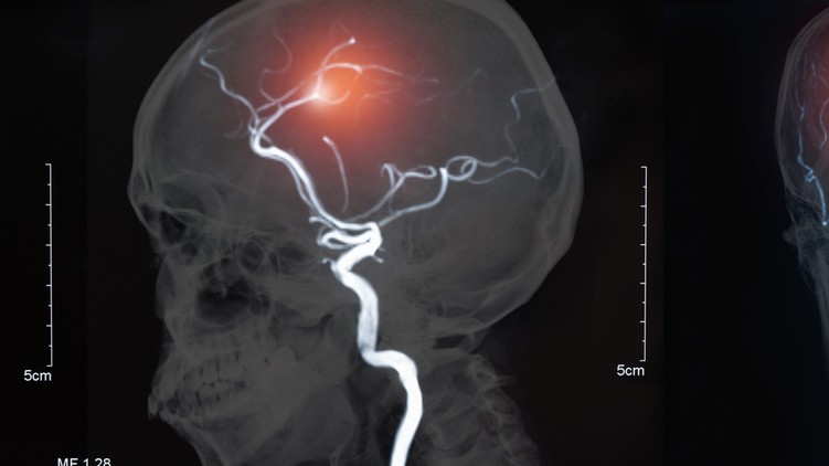 stroke, rehabilitáció, agyi infarktus, beszédzavar, halálozás